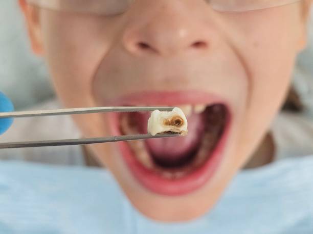 Best Emergency Dental Care for Broken or Chipped Teeth in Lake Camelot, IL